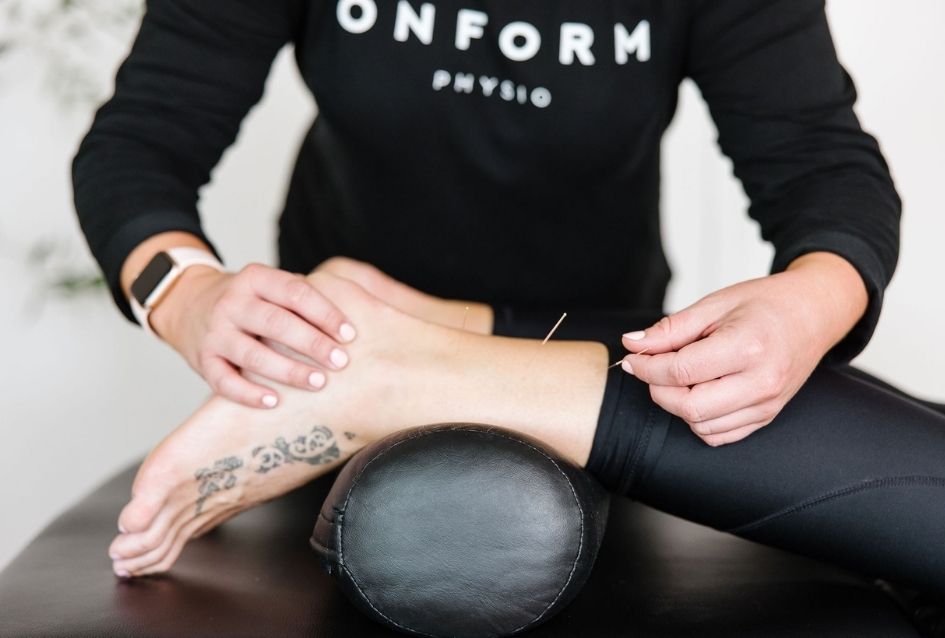 ONFORM Physio Services Acupuncture